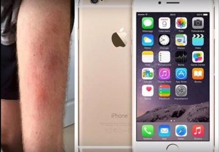 英国一男子将iPhone 6s放裤袋镍过敏，导致大腿又疼又痒