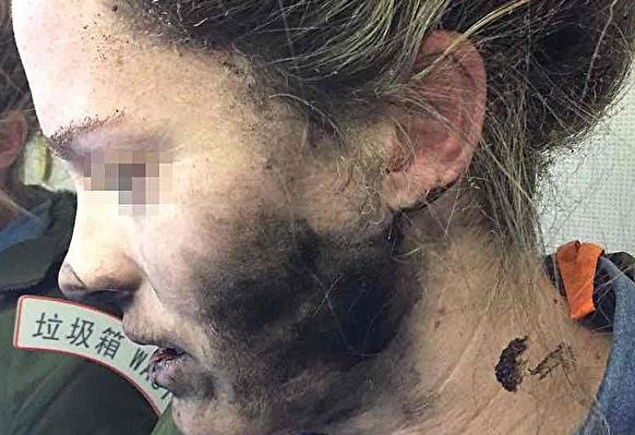 蓝牙耳机电池在飞机上爆炸 澳洲女子脸部炸伤