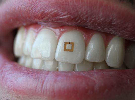 安装在牙齿上的饮食电子跟踪器插图